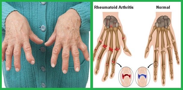 beza gambar rheumatoid arthritis
